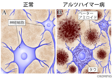 ※アルツハイマー病の原因物質（ベーターアミロイドとタウ）の蓄積